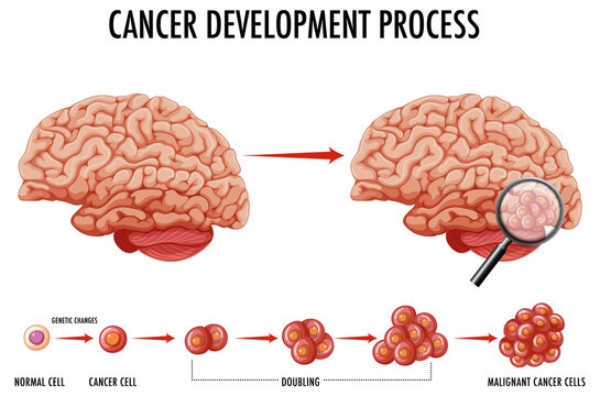 Diagram showing human brain and cancer