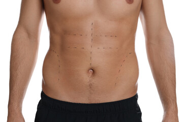Fit man with marks on body against white background, closeup. Weight loss surgery