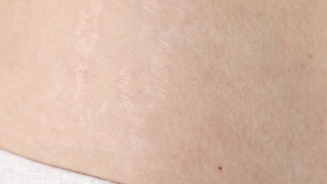 Human body with scars and stretch marks close-up. Violation of skin elasticity.