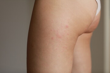 skin allergies, hips skin women. Closeup of red pustules on a hips, an allergic reaction caused by...