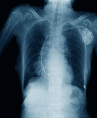 pacemaker cell in patient for keep working electrical wave in human heart 