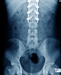 anterior view of structure bone with internal fixation for prevent compression spine bone