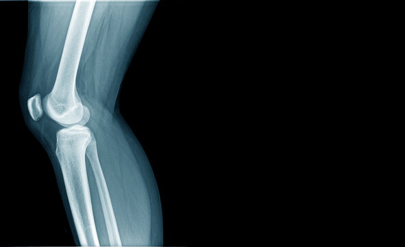 x-ray image og knee joint in blue tone with copy space