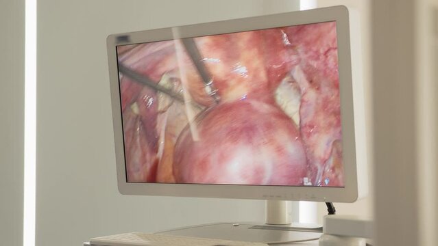 Process of surgery operation using laparoscopic equipment. Operating room with surgery equipment. Medical background. Monitoring the process on screen. Robotic Surgery. Medical operation robot
