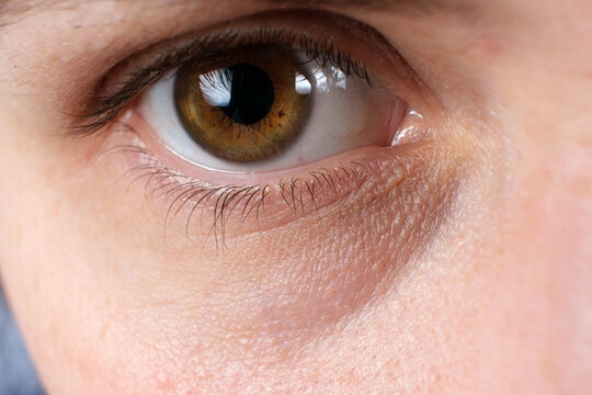A macro photo of the human eye is a bruise under the eye, a tired look