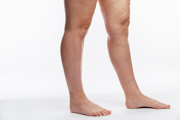 Groomed female legs with cellulite and varicose veins. Disease and obesity. White background.