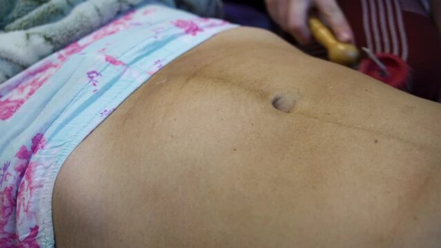 A postpartum doula makes a massage on the belly of a woman after childbirth with a roller with needles. Scar healing after caesarean section.