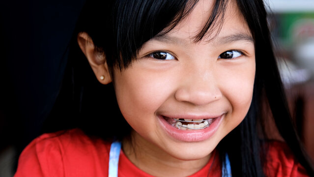 Asian girl wearing removable braces is smiling in a good mood.