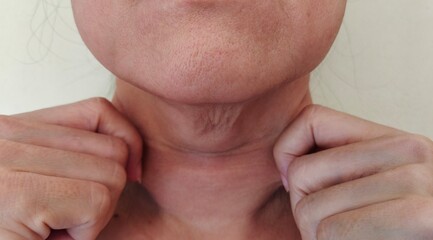 Portrait showing the fingers squeeze flabbiness hanging beside the neck, problem wrinkled and cellulite under the chin of the woman, concept health care.