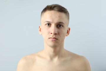 Young man with problem face skin on light background