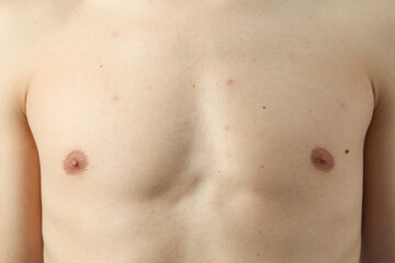 Naklejka premium Concept of skin problems, breast of young man