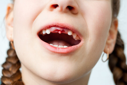 In the child's mouth, two upper front milk teeth were torn out.