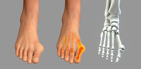 Toe deformation, also known as hallux valgus, or bunion - obrazy, fototapety, plakaty