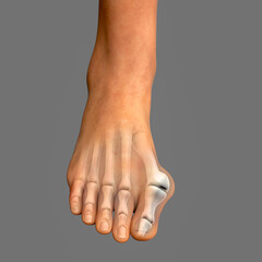 Toe deformation, also known as hallux valgus, or bunion - obrazy, fototapety, plakaty
