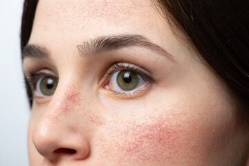 Face of girl with red cheeks from rosacea - obrazy, fototapety, plakaty