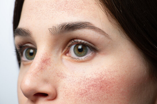 Face of girl with red cheeks from rosacea