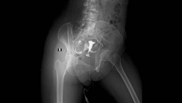 x ray image of  Normal Hysterosalpingography (HSG)