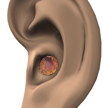 Close-up of ear wax in the human year