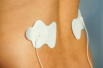 Electrodes on lower back for TENS pain theraphy.