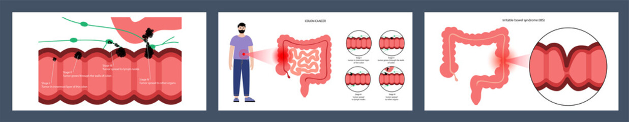 Intestines diseases concept