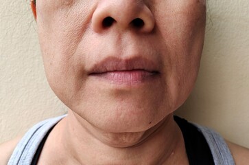 Fototapeta premium Portrait showing the flabbiness adipose hanging on the face, problem wrinkled and cellulite under the eyes of the woman, concept health care.