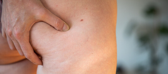Fototapeta premium cellulite or orange crust on feet. Reducing overweight and struggle with cellulite, subcutaneous fat deposition