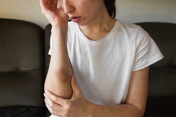 Suffering young woman in white t-shirt with large bruise on arm. Victim of domestic violence.