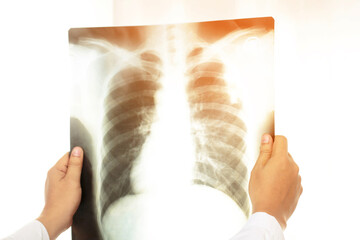 X-ray of the lungs is where X-rays are directed into a part of the chest or lungs where the...