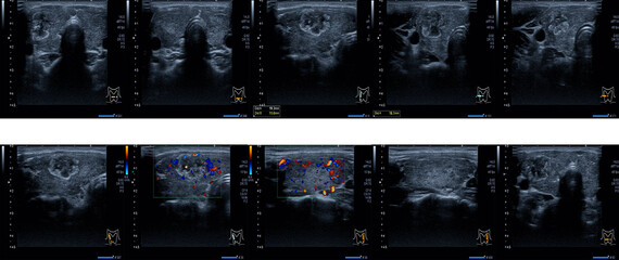 Close up report ultrasound neck and Thyroid gland Medical healthcare concept.