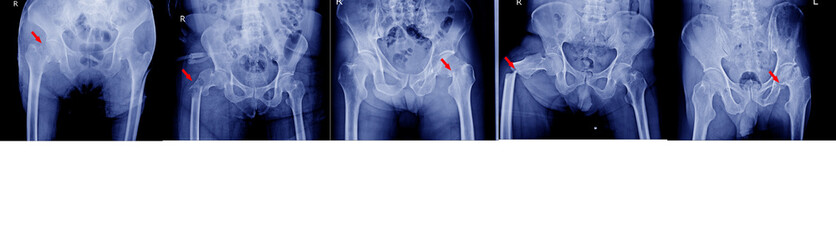 Collection x-ray of pelvis and hips joint different types of fractures Medical image concept.
