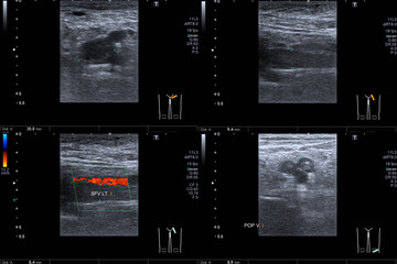 Doppler Ultrasound of Deep Vein Thrombosis Superficial Femoral Vein left thigh Medical healthcare...
