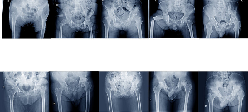 Collection x-ray of pelvis and hips joint different types of fractures Medical image concept.