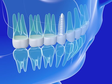 3d illustration of a dental implant. Anatomical image of the teeth and mouth, transparent on a blue background.
