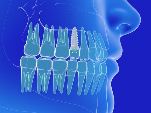 3d illustration of a dental implant. Anatomical image of the teeth and mouth, transparent on a blue background.