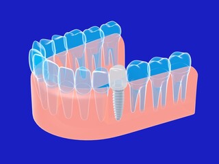 3d illustration of a graphic, isometric style dental implant. Anatomical image of the transparent denture on a blue background.