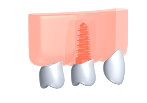 3d illustration of a dental implant in a gum. Ixometric graphic style. Anatomical image of denture on white background.