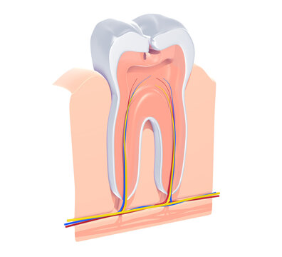 3d illustration of the anatomical view of a tooth damaged by caries. Showing the interior, veins, arteries and nerve, gum and bone.