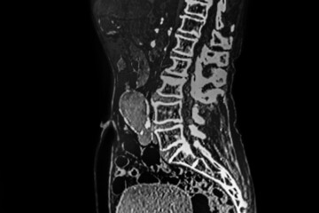 Volumetric angiotomography of the abdominal aortic aneurysm with a diameter 8.2 cm X 4 cm and intraluminal thrombus.
