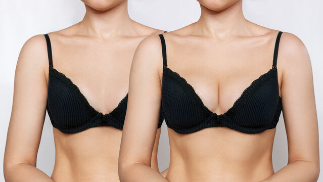 Cropped shot of young tanned woman in bra before and after breast augmentation with silicone implants. The result of a breast lift. Breast size correction on gray background. Plastic surgery concept