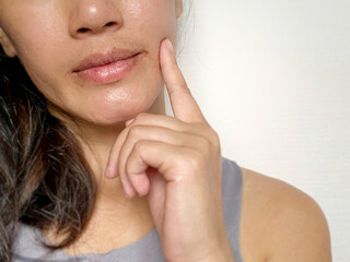 Woman with chapped and dry lips background. Health care concept.