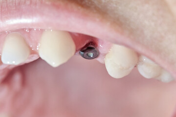 Close up of a real mouth with dental molar screw implant.