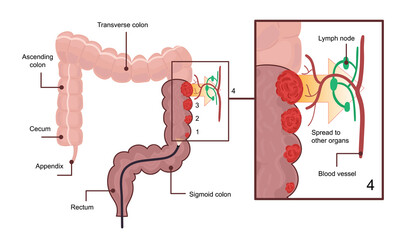 Medical diagram of colon cancer. scheme - obrazy, fototapety, plakaty