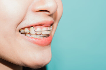 Close up white teeth of young Asian beautiful woman smiling wear silicone orthodontic retainers on teeth isolated on blue background, retaining tools after removable braces. Dental hygiene health - obrazy, fototapety, plakaty