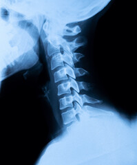 xray of the cervical spine painful