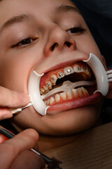 White retractor on lips and installation of metal braces on teen's upper teeth.