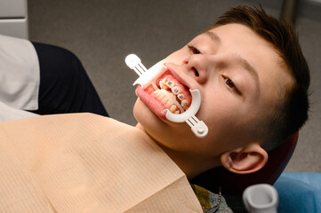 Visit to the orthodontist, installation of braces on the upper teeth, white retractor on the lips...