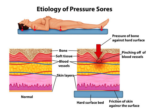 Etiology of pressure sores