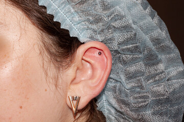 Female ear cartilage piercing freshly done with classic ball titanium labret. A healed earlobe...