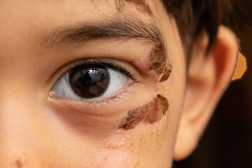 Macro of a child's eye with abrasions near the temple.