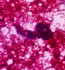 Fine needle aspiration (FNA) cytology of chronic sialadenitis of neck, show cellular material composed of salivary acini, lymphocytes and histiocytes on background of blood.